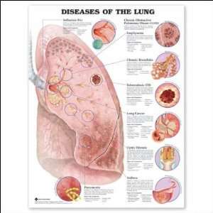  Diseases of the Lung Anatomical Chart 20 X 26 Laminated 