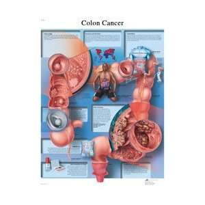  3B Scientific® Anatomical Charts   Colon Cancer 