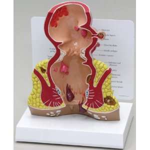Rectum Model Human with Cancer  Industrial & Scientific
